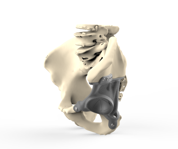 Custom-made flexible cone with TrabecuLink®